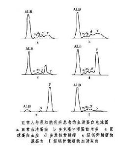 血清蛋白电泳图