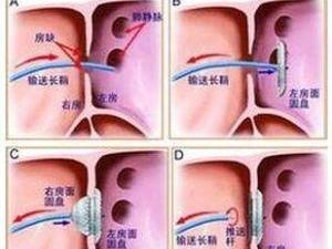 房间隔发育过程图片图片