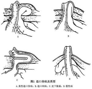 造口旁疝