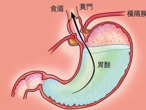 胃反酸