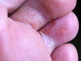 足癣 真菌感染的皮肤病 搜狗百科