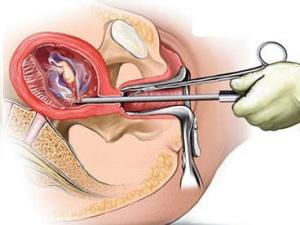 人工流产手术