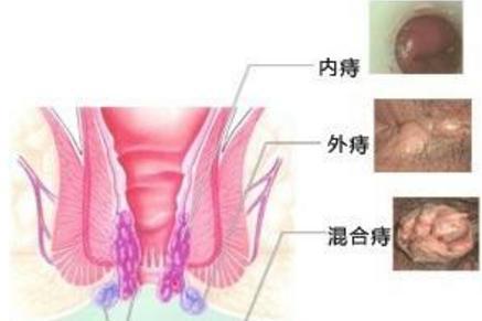外痔 搜狗百科