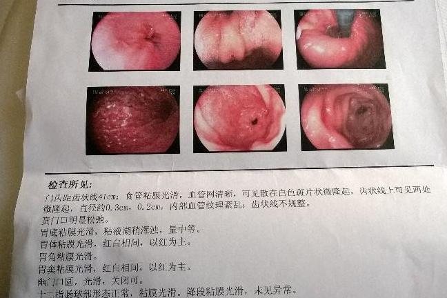 慢性非萎缩性胃炎 慢性胃炎 搜狗百科