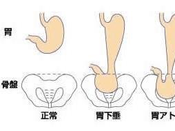 胃下垂 搜狗百科 胃下垂 搜狗百科