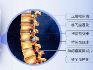 急性腰椎间盘突出