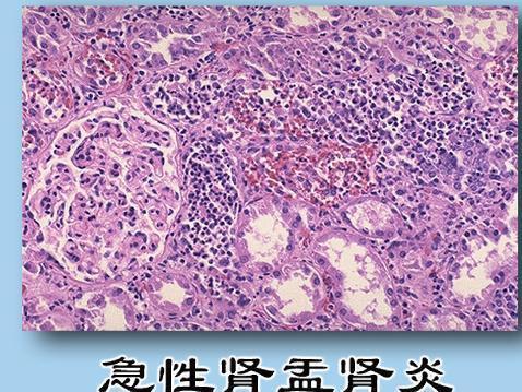 肾盂肾炎 搜狗百科 肾盂肾炎 搜狗百科