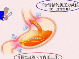 胆汁反流性胃炎