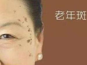 老年斑