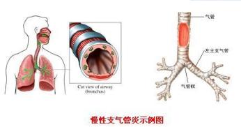 气管炎