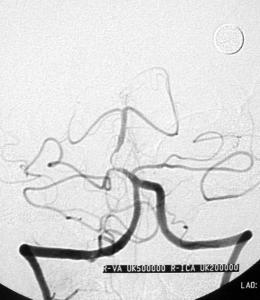 椎-基底动脉供血不足
