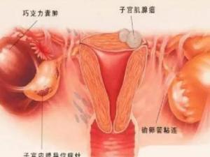 子宫腺肌症