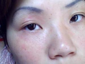 面部皮肤过敏