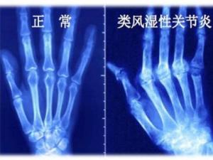 类风湿关节炎