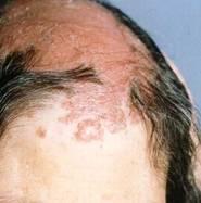 头皮鳞癌早期症状图片图片