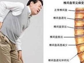 急性腰椎间盘突出
