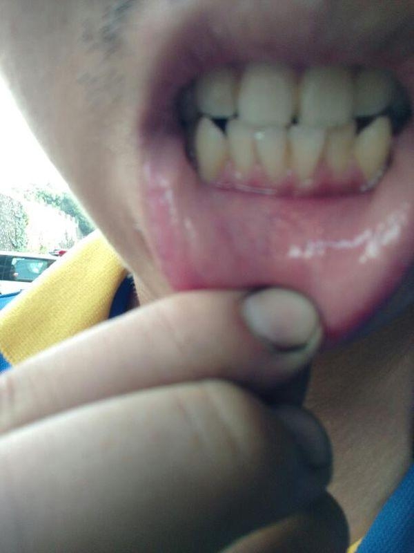 如何快速解决牙根痛 0