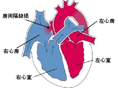 心内膜垫缺损ppt图片