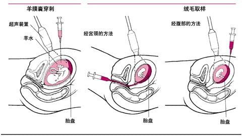 绒毛取样