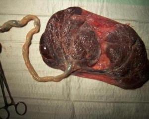 胎膜残留物图片