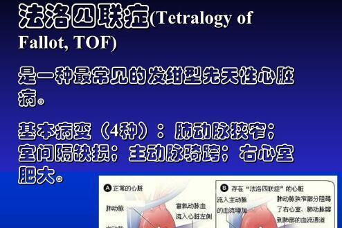 法洛四联症 搜狗百科 法洛四联症 搜狗百科