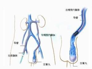 精索静脉曲张