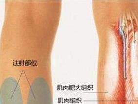 瘦腿针