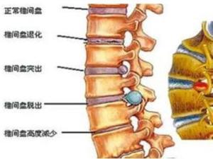 急性腰椎间盘突出