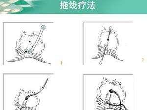 肛门瘘管