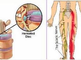 急性腰椎间盘突出