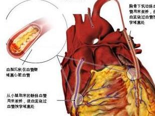 右室心肌梗死