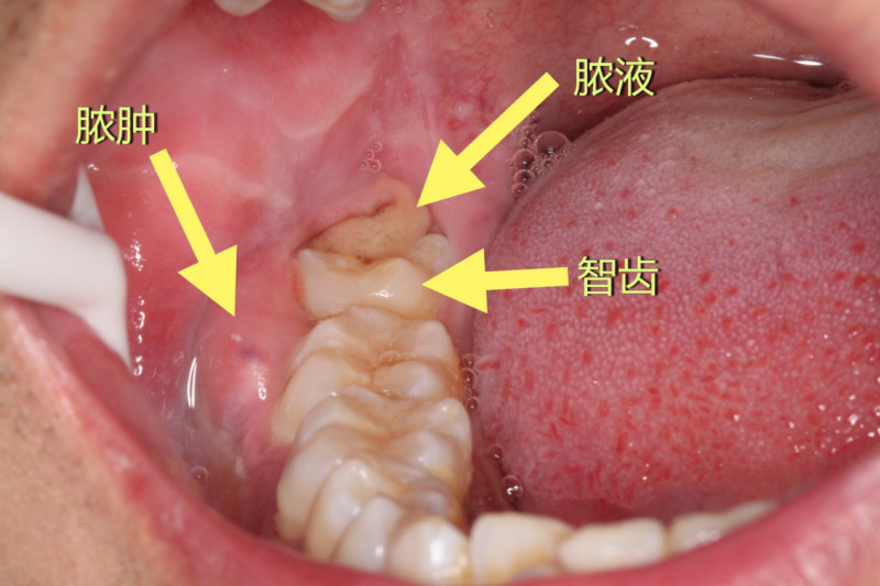 智齿 人类口腔内的第三颗磨牙 搜狗百科