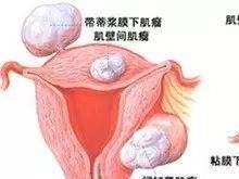 妇科病