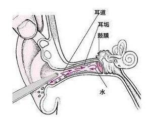 耵聍腺位置图片