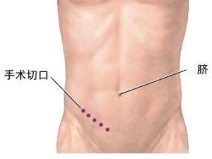 急性阑尾炎