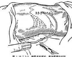 什么是动脉灌注 0