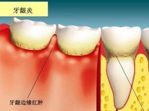 牙龈炎