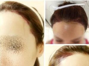 发际线调整 发际线调整