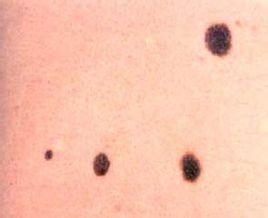 身上长的黑痣,应该如何祛除?