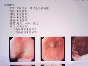 恶性食管乳头状瘤图片