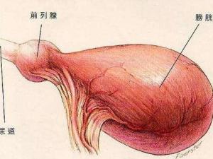 膀胱炎