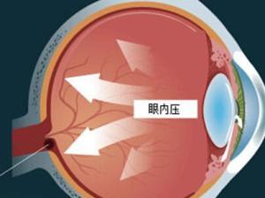 眼压高