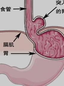 食管裂孔疝