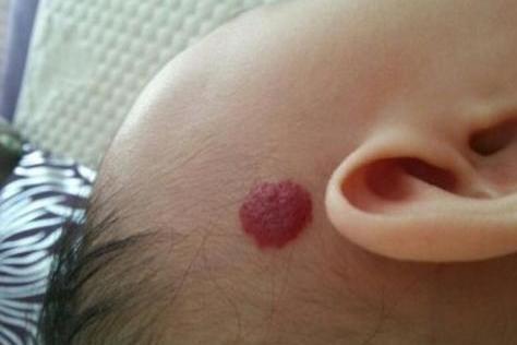 血管瘤 搜狗百科 血管瘤 搜狗百科