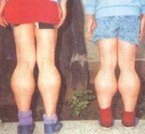 肌肉假肥大 - 搜狗百科