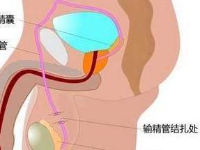 男性结扎手术