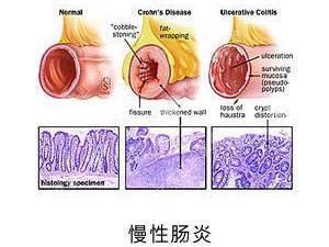 慢性肠炎