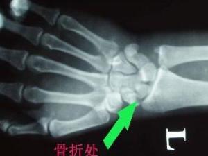 手腕骨折
