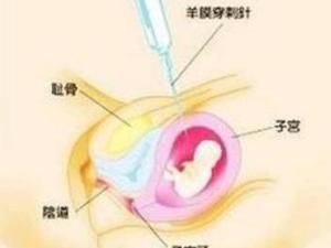 羊水穿刺检查 羊水穿刺检查