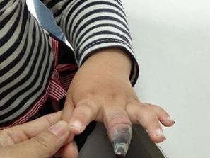 4岁女童贴创可贴 因使用不当要截肢